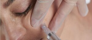 Microneedling Treatments