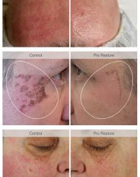 Dermalogica-Pro-Restore-before-and-after-images